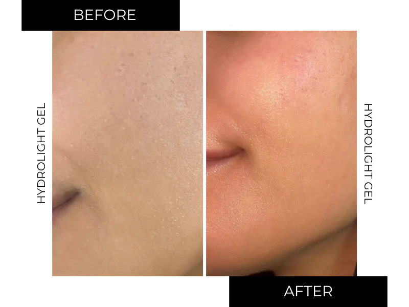 NO-ACNE PACK - Image 14