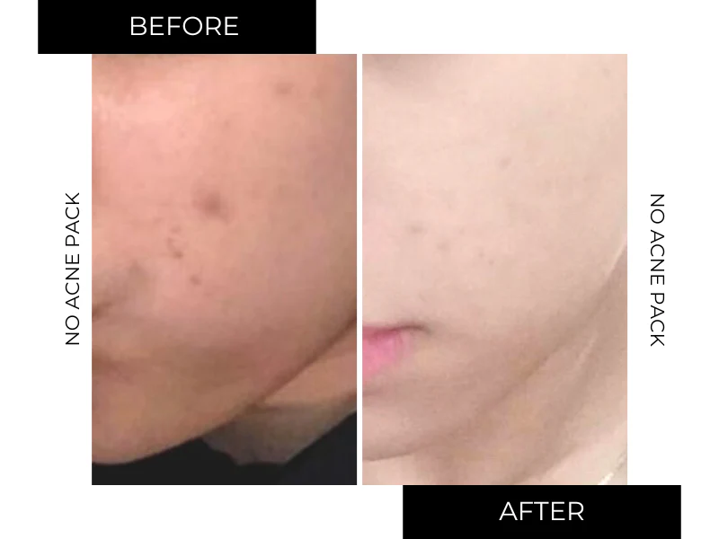 NO-ACNE PACK - Image 11