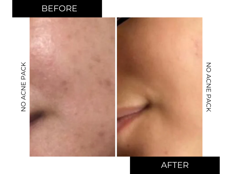 NO-ACNE PACK - Image 12