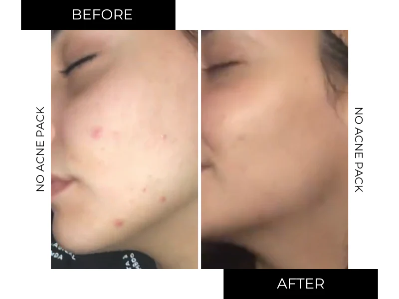 NO-ACNE PACK - Image 13