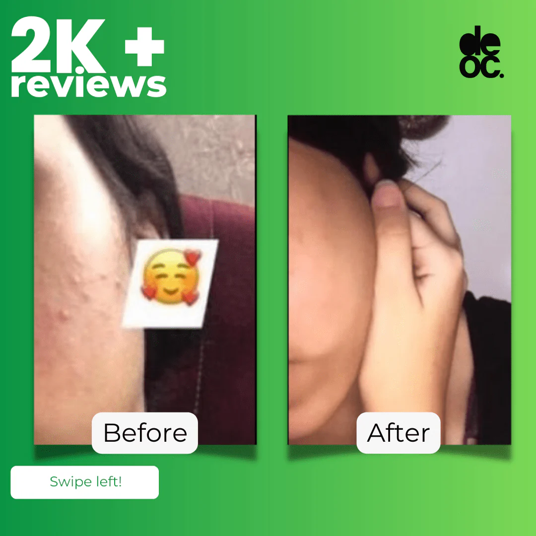 NO-ACNE PACK - Image 4